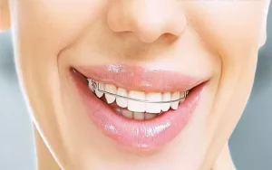 مزایای ارتودنسی فانکشنال 