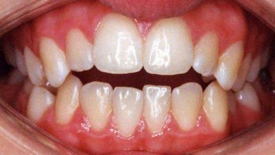 دندان خرگوشی