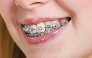 تفاوت اصلی ارتودنسی ثابت با ارتودنسی متحرک در نوع دستگاه آنهاست.