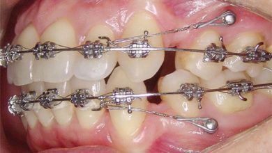 معایب ارتودنسی دندان