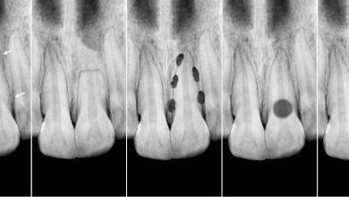 تحلیل ریشه دندان