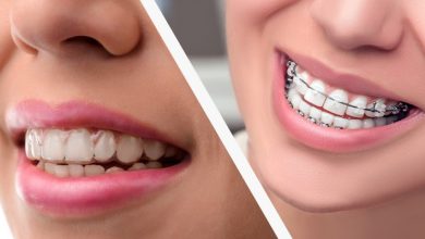 اینویزیلاین چیست؟