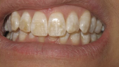 فلوئوروزیس