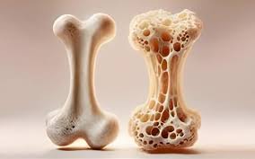 پوکی استخوان، یک بیماری مزمن است که با کاهش تراکم استخوان و افزایش احتمال شکستگی‌ها همراه است.