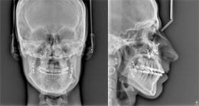 سفالومتری لترال