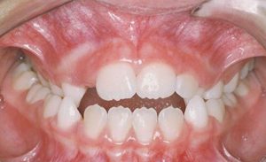 کراس‌بایت چیست؟ (Crossbite)