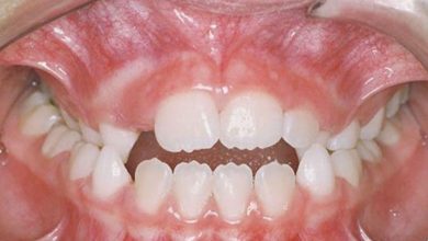 کراس‌بایت چیست؟ (Crossbite)